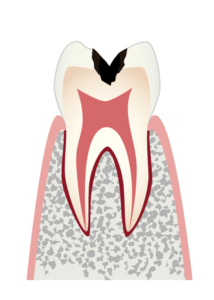 歯の内部（象牙質）まで進行した虫歯
