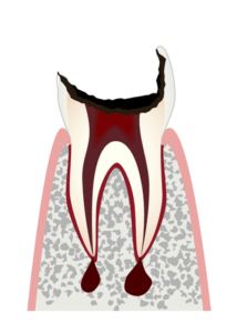 歯根まで進行した虫歯