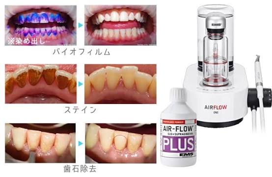定期検診で健康な歯を守りましょう